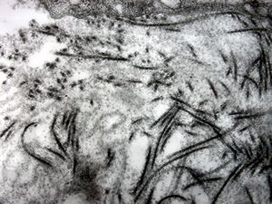 M, 40y. | reticular erythematous mucinosis M, 40y. | reticular erythematous mucinosis